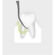 1942 712 Piezo Scaler-Tip 2Pl  Tooth iillustration 72dpi